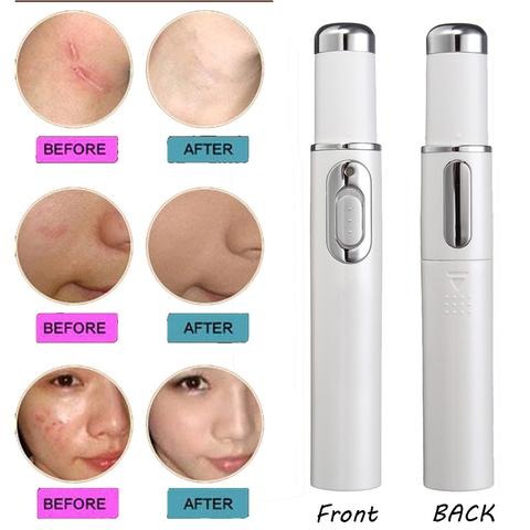 Acne Laser Treatment Pen